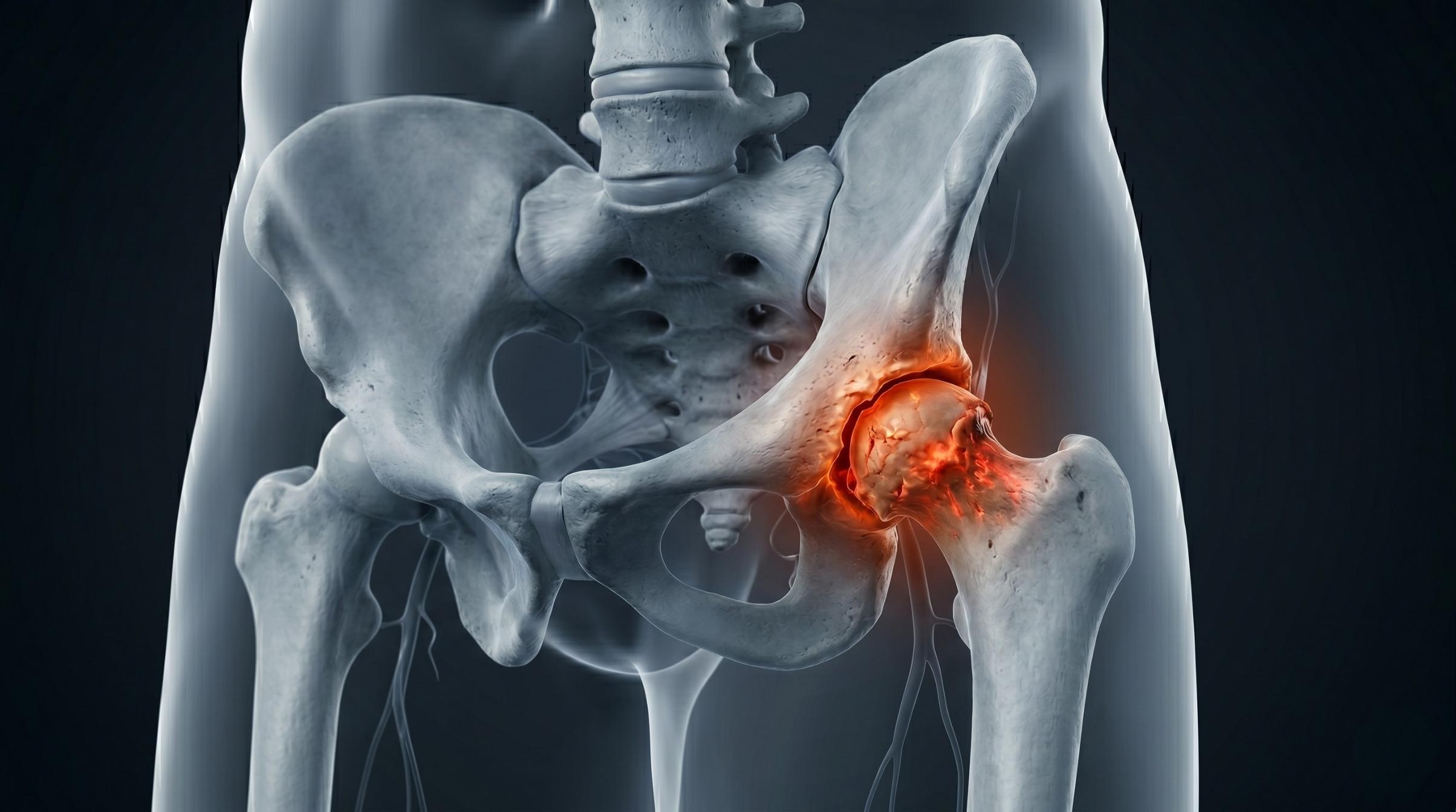 Illustration of an arthritic hip joint
