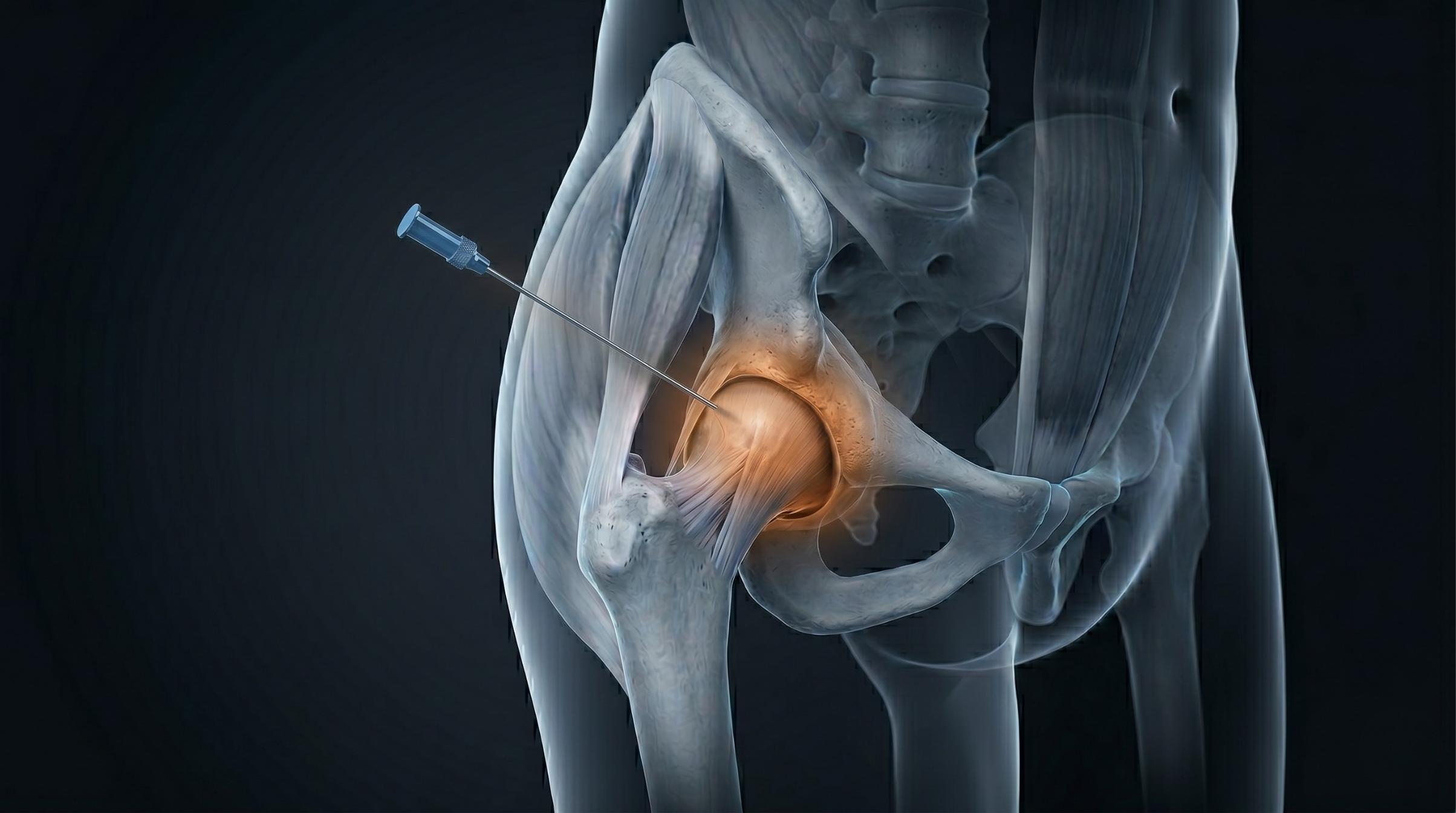 A hip joint injection being administered