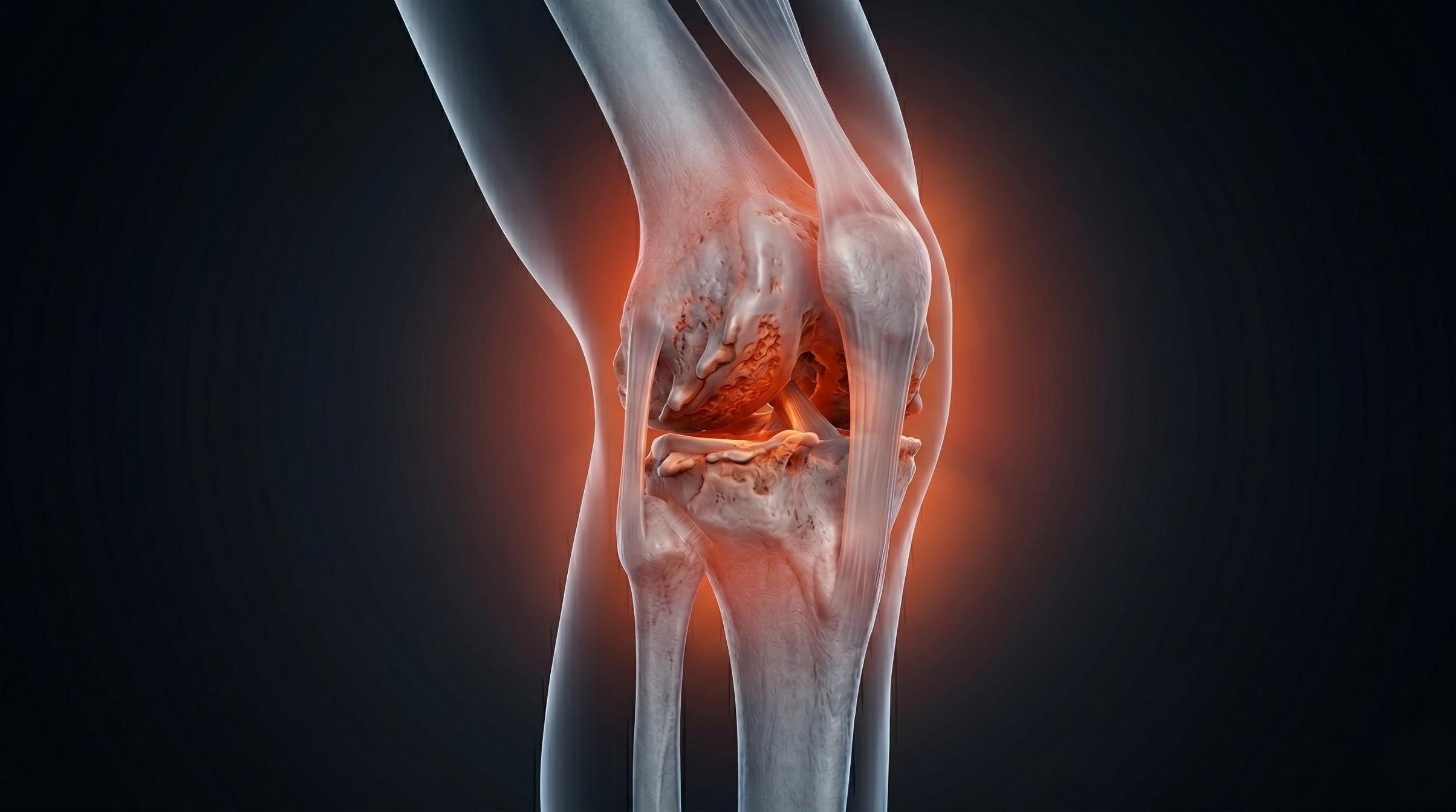 Illustration of an arthritic knee joint