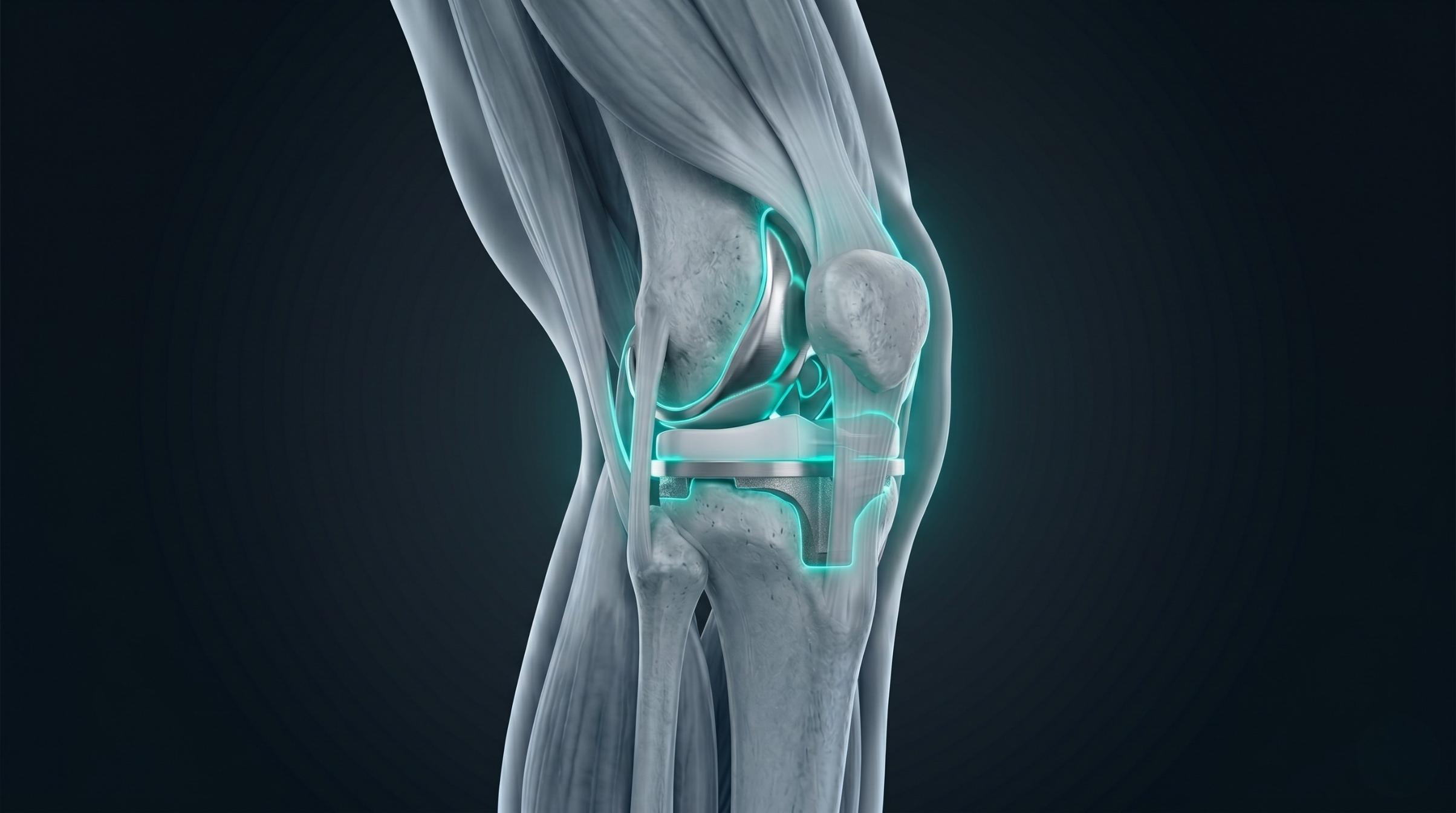 3D render of total knee replacement implant